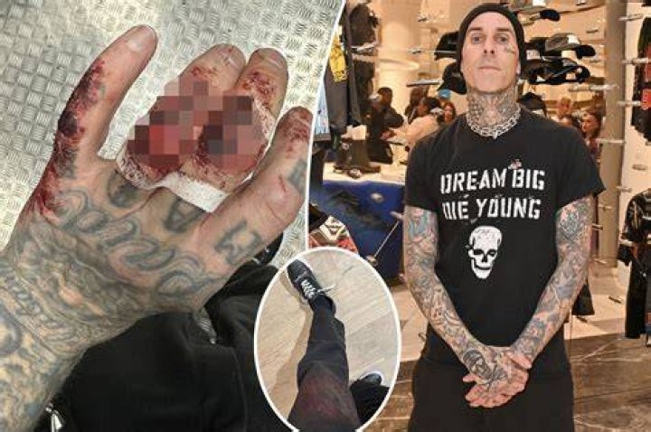 Gory injury: 'I fell in, the branch broke, I hit a stick. It just lacerated... but it's OK. It's just an open would. All I need is a couple of stitches', army veteran EJ told a female member of the show's medical team