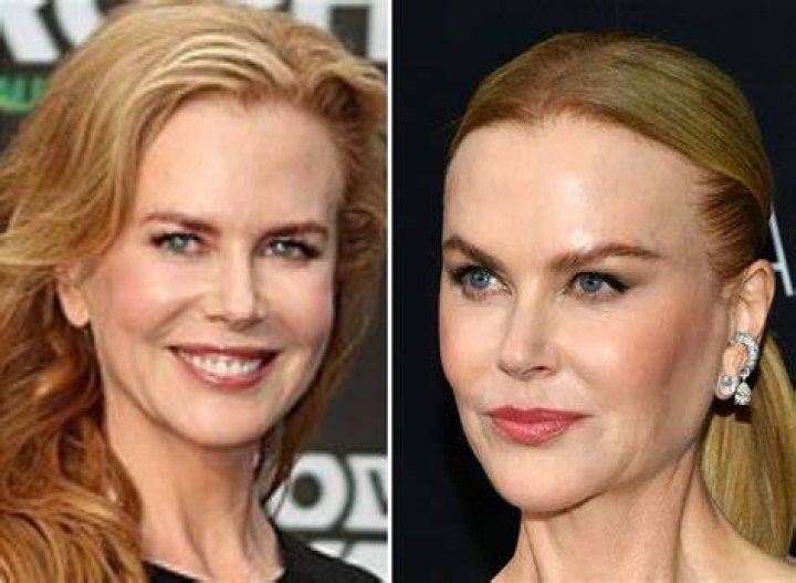 Nicole Kidman Plastic Surgery Inside Her Cosmetic Transformation Dr. Brandon Richland, MD