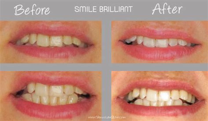smile brilliant before and after reviews